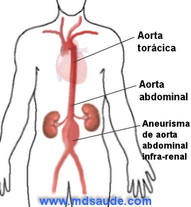 Cirurgia Aorta