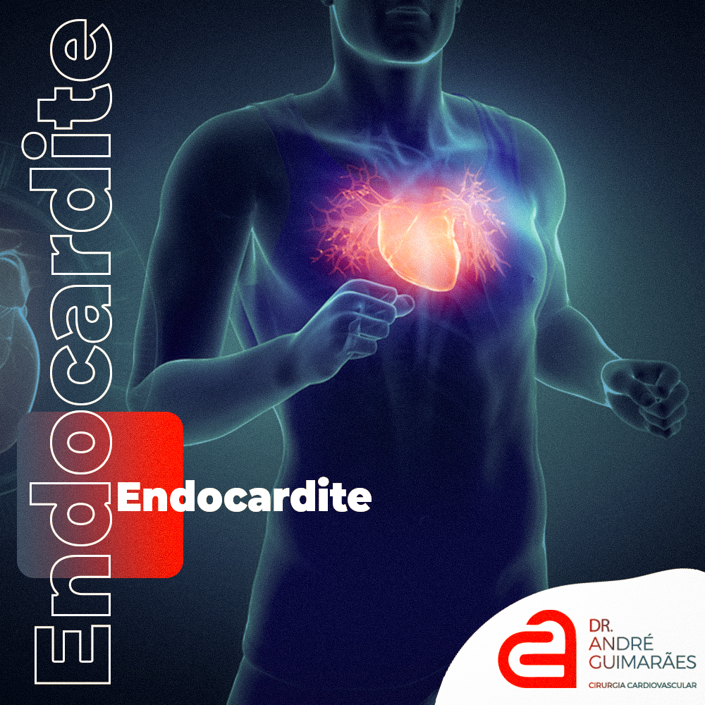 Endocardite: Você sabe o que é?